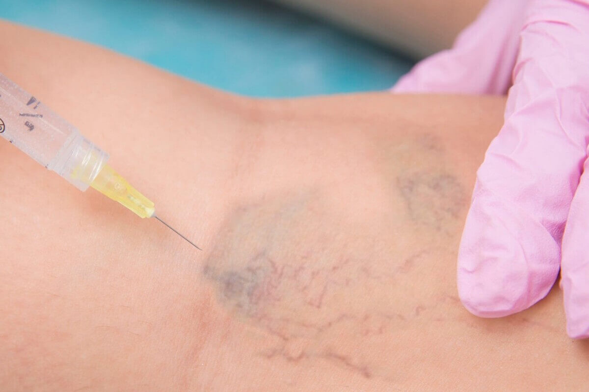 Remoção Microvasos